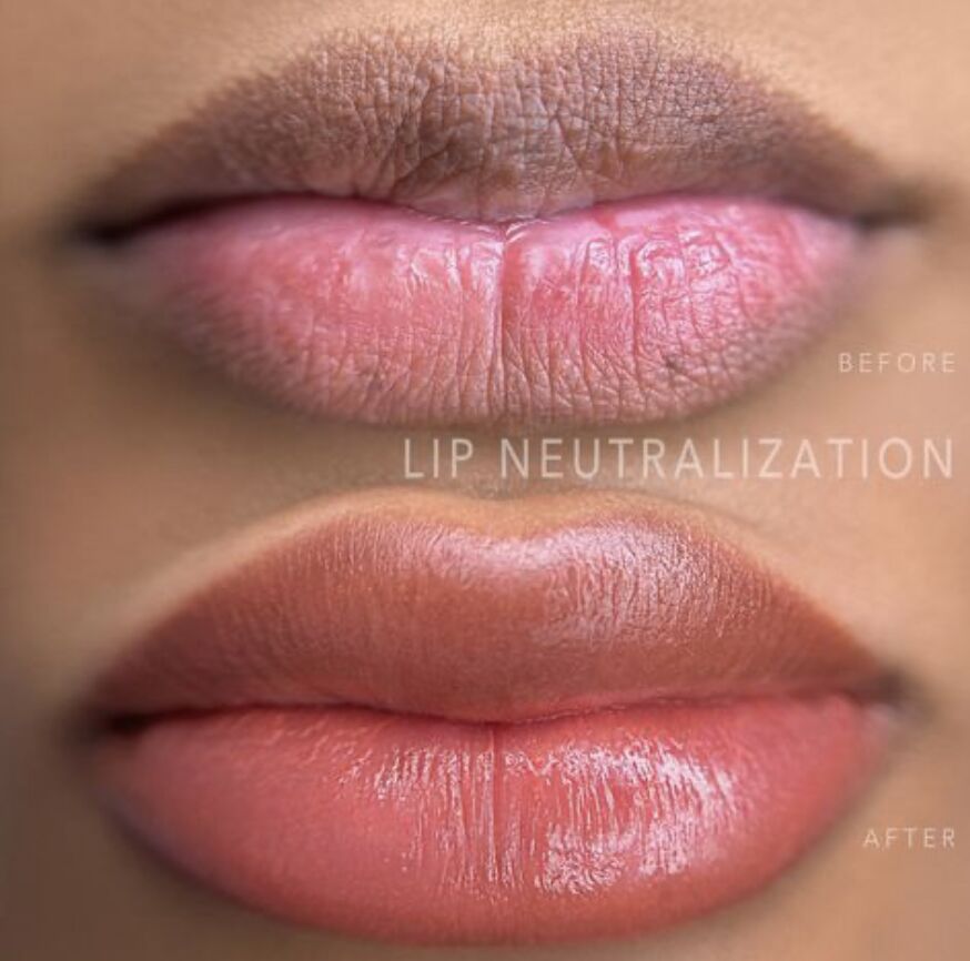 Lip Neutralization before and after